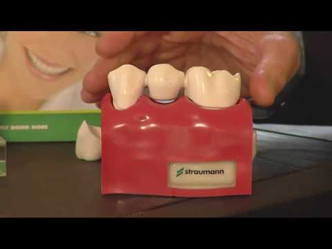 Youtube: Was ist ein Zahnimplantat